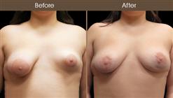 Breast Reconstruction Before And After