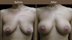 Breast Implant Surgery Before And After Front Image