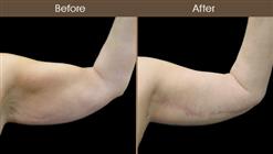 Before And After Arm Lift Front Image