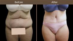 Before & After Body Lift Surgery