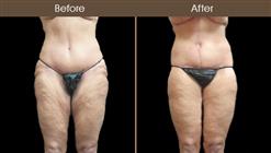 Thigh Lift Before & After