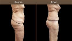 Before & After Body Lift Surgery In NYC