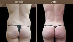 Before & After Gluteal Fat Grafting