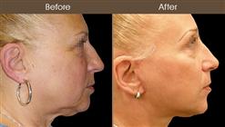 Face Lift Treatment Before And After