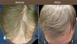 Before & After Hair Restoration