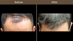 Hair Restoration Treatment Before And After