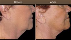 Necklift Surgery Results