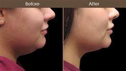 Scarless Face Lift Results