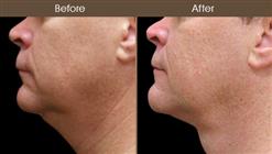 Scarless Neck Lift Before & After
