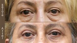 Before & After Blepharoplasty In NYC