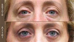Before & After Blepharoplasty Surgery In NYC