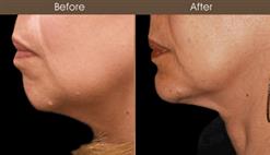 Before And After Chin Augmentation