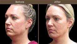 Before And After Scarless Face Lift Surgery