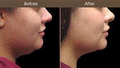 Before And After Scarless Necklift