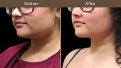 Scarless Necklift Before & After