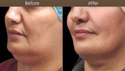 Scarless Facelift Results