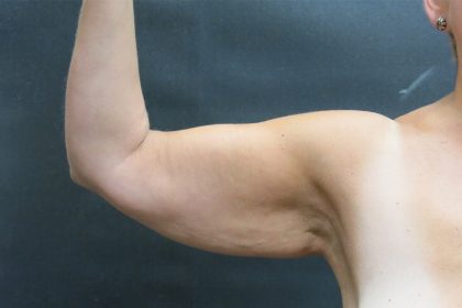 Arm Lift Before & After Patient #888