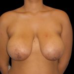 Breast Reduction Before & After Patient #1398