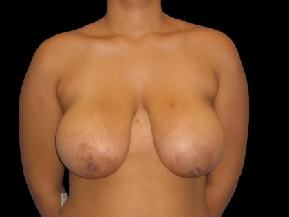 Breast Reduction Before & After Patient #1398