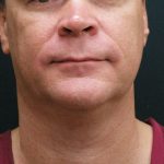 Scarless Facelift and Necklift Before & After Patient #3042