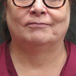 Scarless Facelift and Necklift Before & After Patient #3049