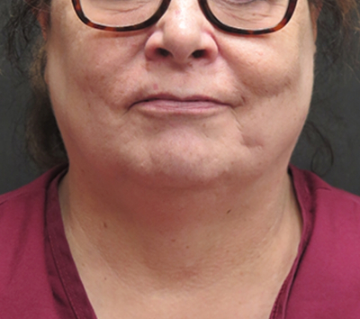 Scarless Facelift and Necklift Before & After Patient #3049