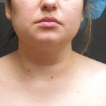 Scarless Facelift and Necklift Before & After Patient #3067