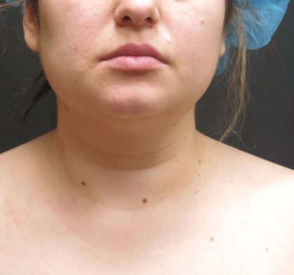 Scarless Facelift and Necklift Before & After Patient #3067