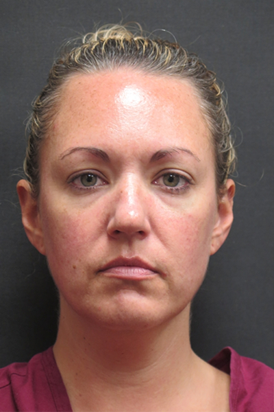Scarless Facelift and Necklift Before & After Patient #3101