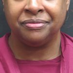 Scarless Facelift and Necklift Before & After Patient #1910