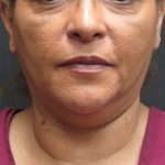 Scarless Facelift and Necklift Before & After Patient #3081