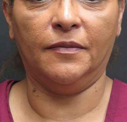 Scarless Facelift and Necklift Before & After Patient #3081