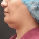 Scarless Facelift and Necklift Before & After Patient #3094