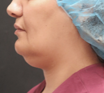 Scarless Facelift and Necklift Before & After Patient #3094