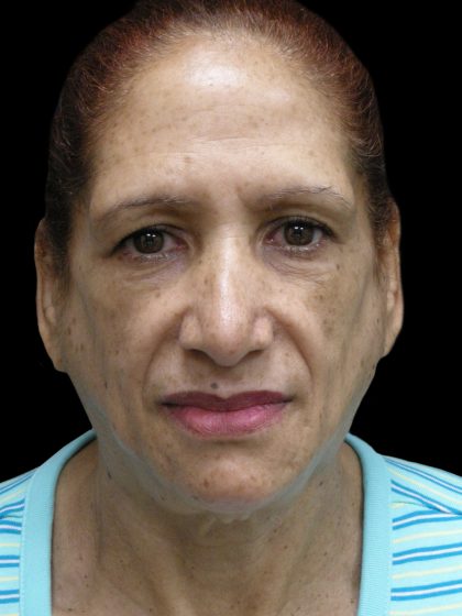 Fat Transfer Before & After Patient #1765