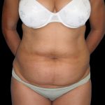 Tummy Tuck Before & After Patient #3146