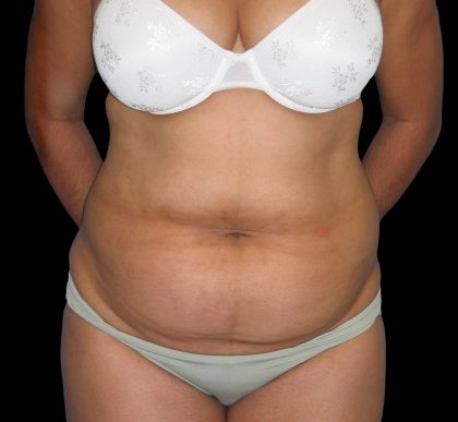 Tummy Tuck Before & After Patient #3146