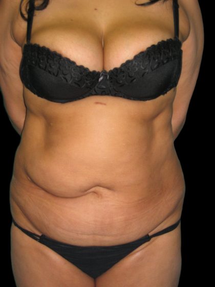 Tummy Tuck Before & After Patient #3155