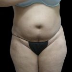 Tummy Tuck Before & After Patient #3166