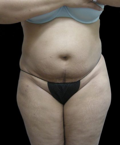 Tummy Tuck Before & After Patient #3166