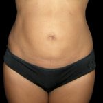 Tummy Tuck Before & After Patient #3175