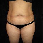 Tummy Tuck Before & After Patient #3186