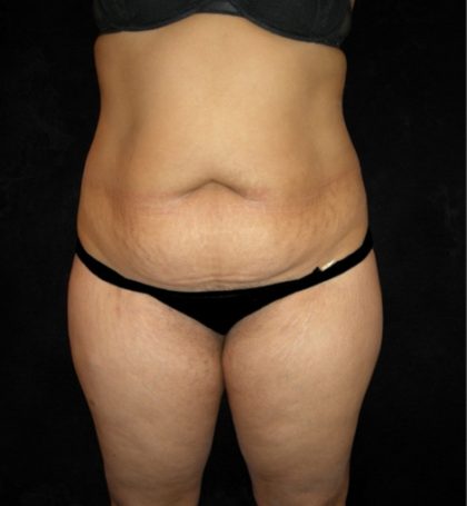 Tummy Tuck Before & After Patient #3186