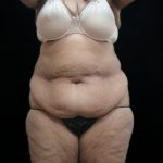 Tummy Tuck Before & After Patient #3209