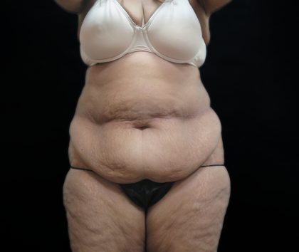 Tummy Tuck Before & After Patient #3209