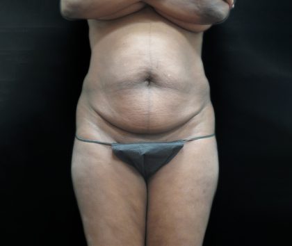 Tummy Tuck Before & After Patient #3216