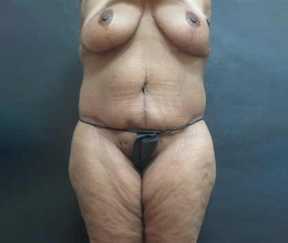 Tummy Tuck Before & After Patient #3225