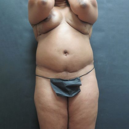 Tummy Tuck Before & After Patient #3254