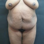 Tummy Tuck Before & After Patient #3279