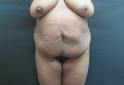 Tummy Tuck Before & After Patient #3279